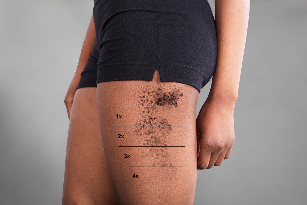 Laserowe usuwanie tatuaży – jak zadbać o skórę bezpośrednio po zabiegu?